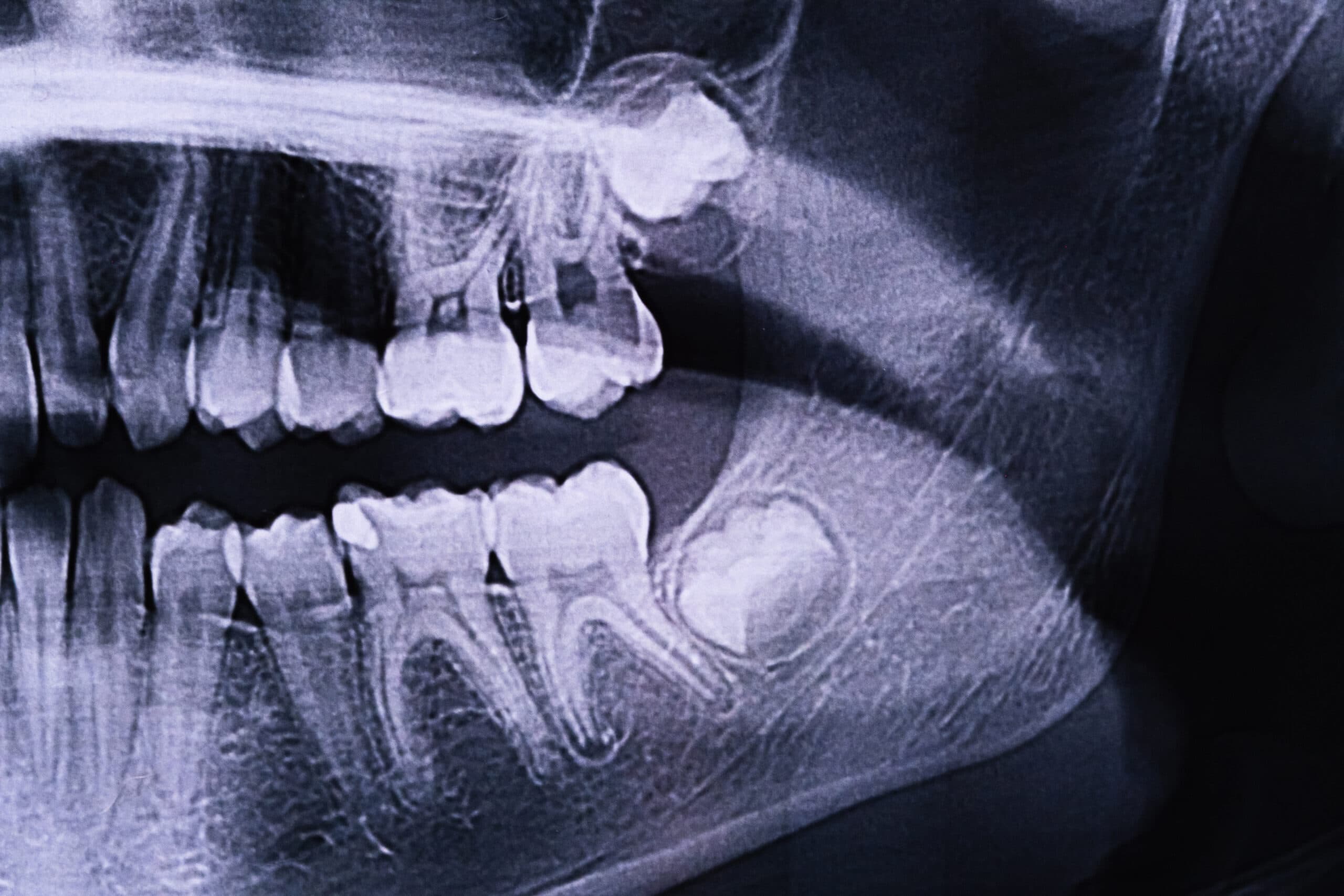 Dental X-ray used to evaluate candidacy for dental implants